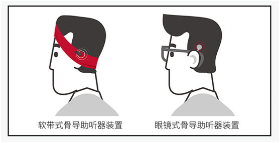 【单侧耳聋的听力干预方案】(图2)