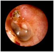 【传导性听力损失的发病原因】(图3)