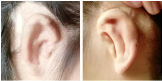 牙骨传导技术干预双侧传导性听力损失（小耳畸形）(图1)