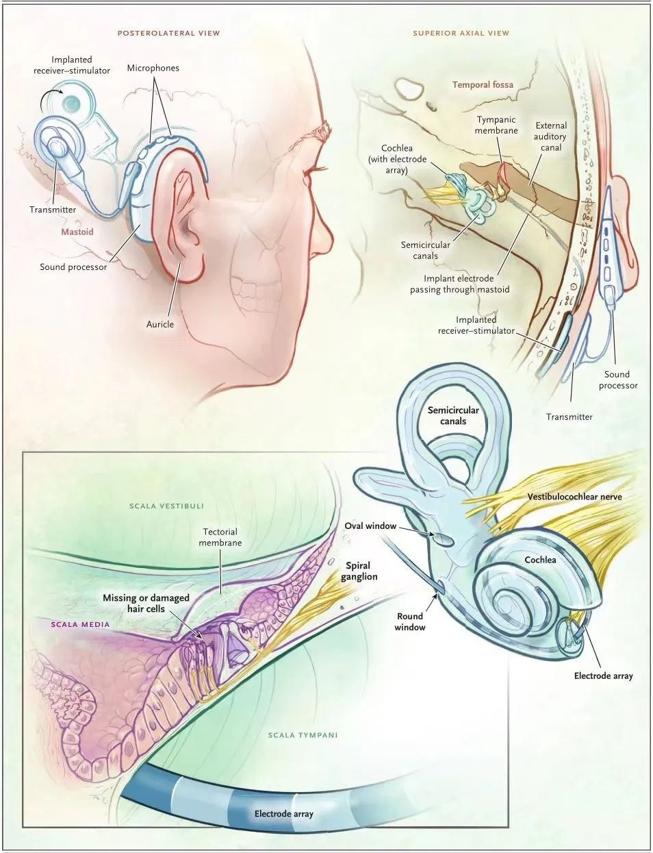 【神外科普 | 听神经瘤患者听力重建】(图4)