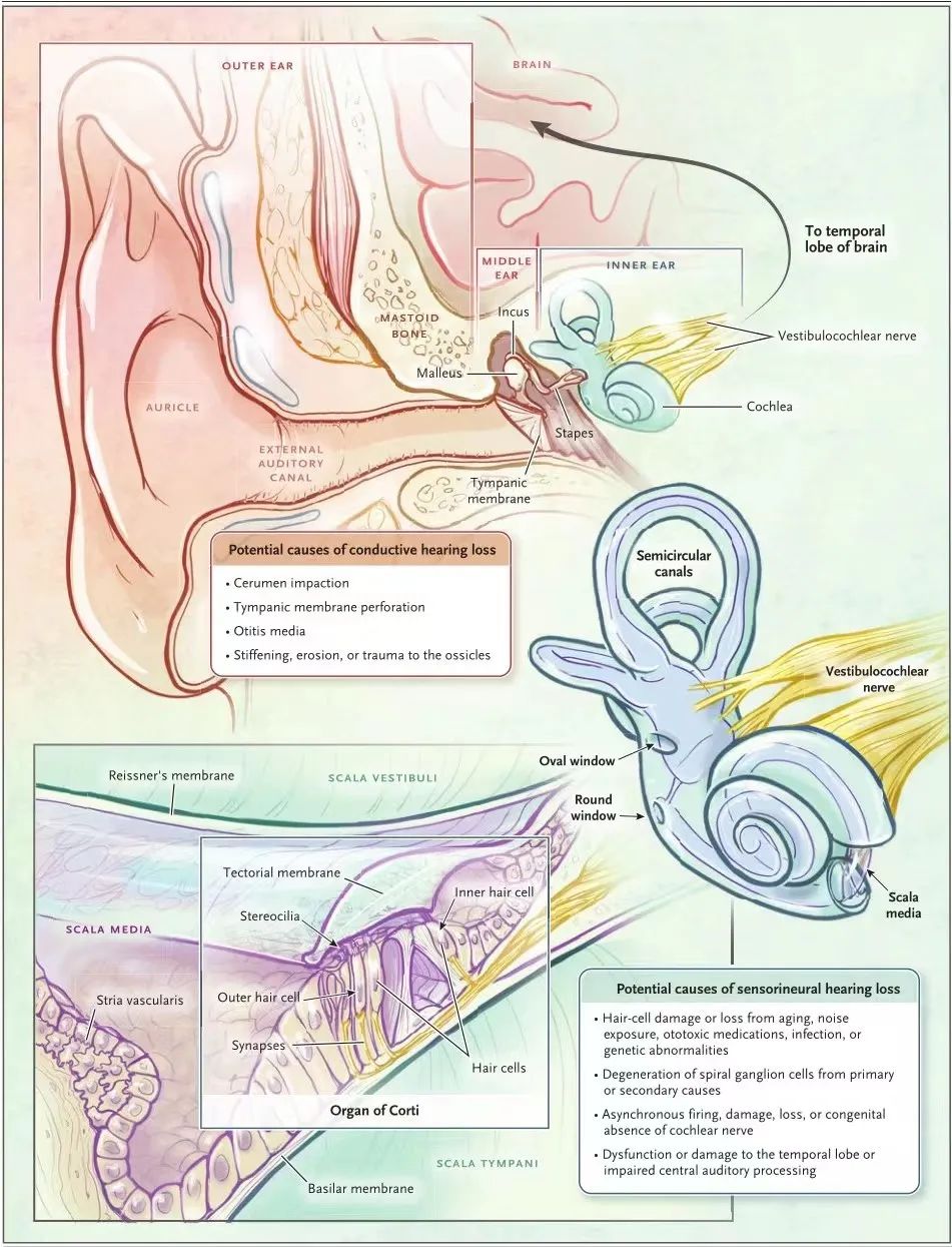 【神外科普 | 听神经瘤患者听力重建】(图3)