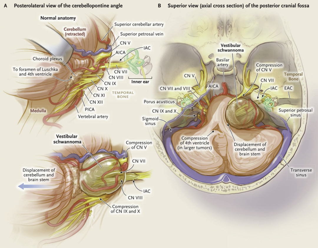 【神外科普 | 听神经瘤患者听力重建】(图1)