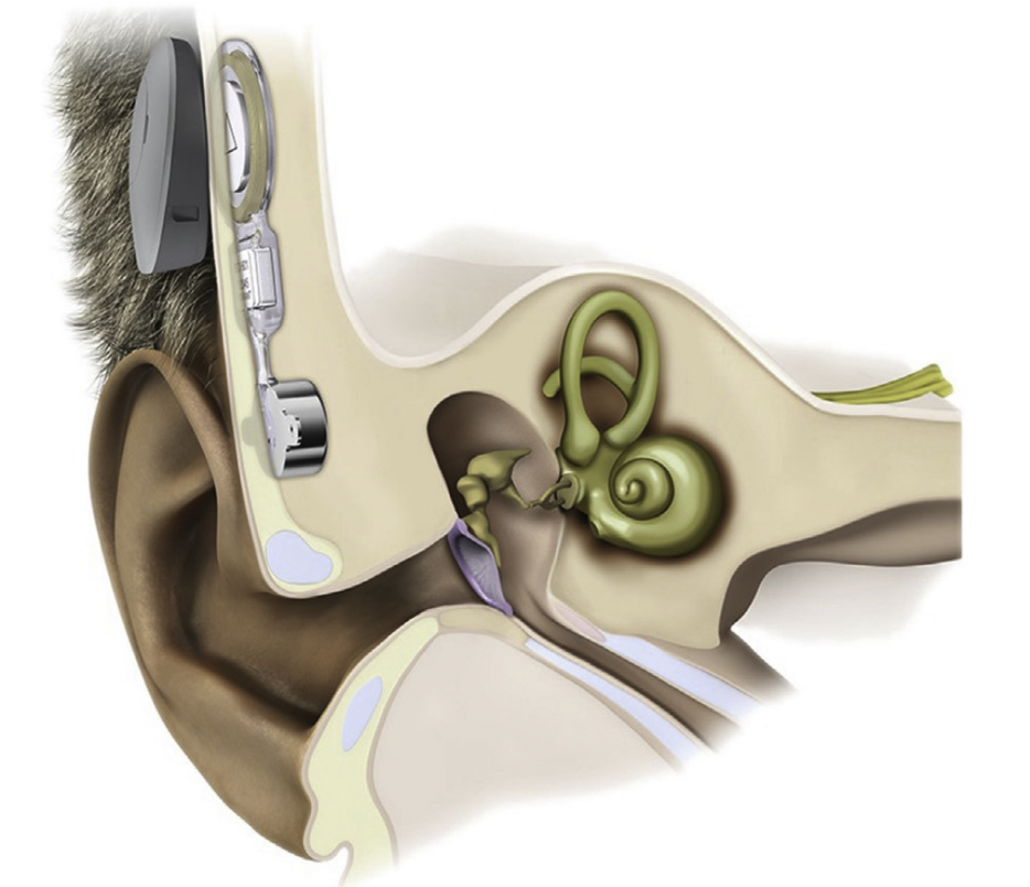 【神外科普 | 听神经瘤患者听力重建】(图5)